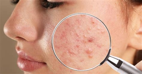 Espironolactona serve para acne Médico Responde