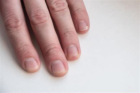 Premium Photo Male Hand With A Broken Nail On The Little Finger