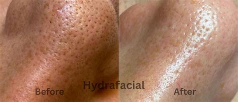 Morpheus Radio Frequency Micro Needling Before And After Picture