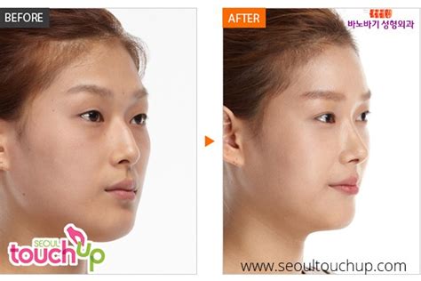 Plastic Surgery Before And After Nose Korean