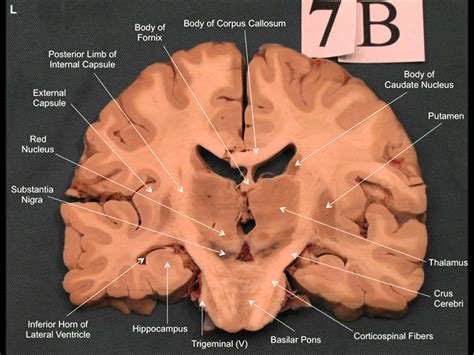 Coronal Section Of Brain Drawing