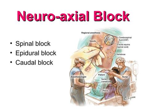 Regional Anesthesia | PPT