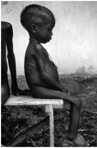 KWASHIORKOR