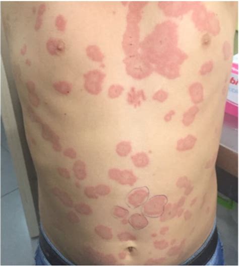 Frontiers The Many Faces Of Pediatric Urticaria