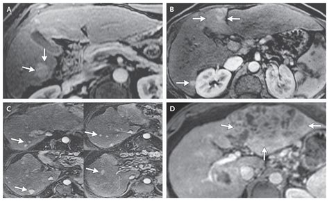 Hepatocellular Carcinoma New England Journal Of Medicine