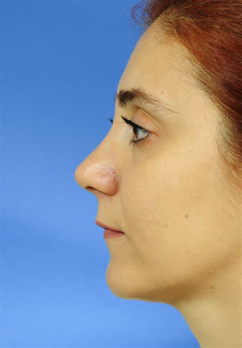 Rhinoplasty Nose Job Otoplasty Prof Dr Selçuk İnanlı