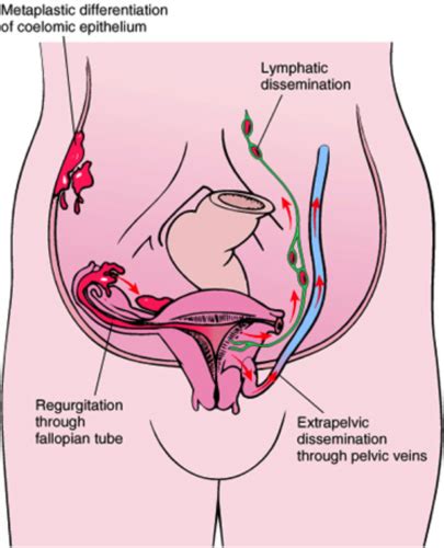 22 Uterine Pathology Flashcards Quizlet