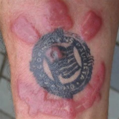 Remoção De Tatuagem Dá Queloide Na Pele