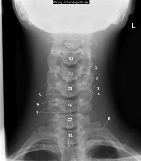 Cervical Spine Xray