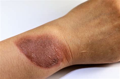 Steam Or Scald Burn Stock Image Image Of Blisters Accident 179165355