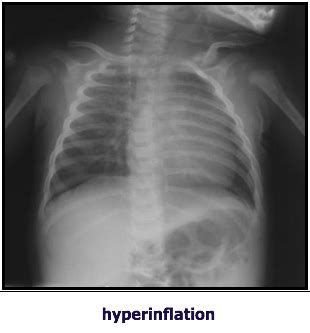 Respiratory Infections Flashcards Quizlet