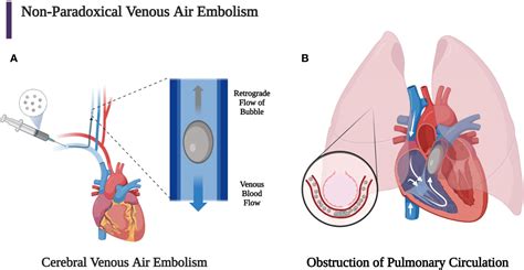 Trendelenburg Position For Air Embolism