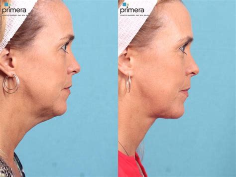 Submentoplasty Chin Tuck Before And After Pictures Case 462 Orlando Florida Primera