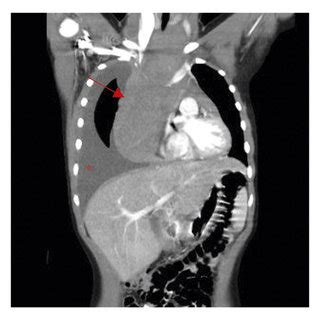 Imaging of mediastinal mass and pathology of lymph node biopsy sample ...