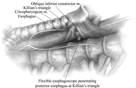 Primary Repair Of Esophageal Perforation Operative Techniques In