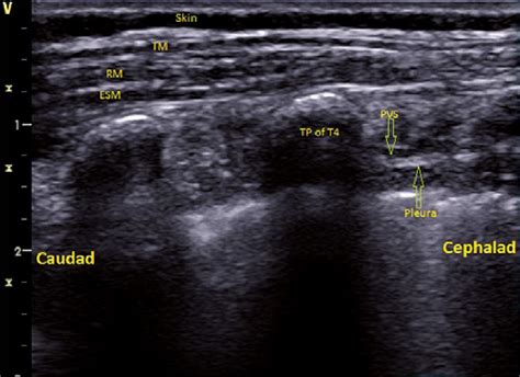 Paravertebral Block Ultrasound