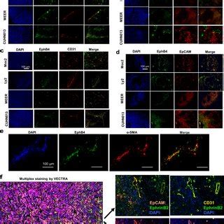 Variable Expression Of Ephb And Ephrinb Is Found On Hnscc Tumor Cells