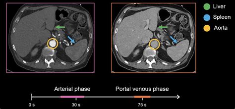 Abdominal CT Phases LITFL Radiology Library