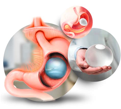 Documentos ABC Endoscopia Balão Intragástrico SP