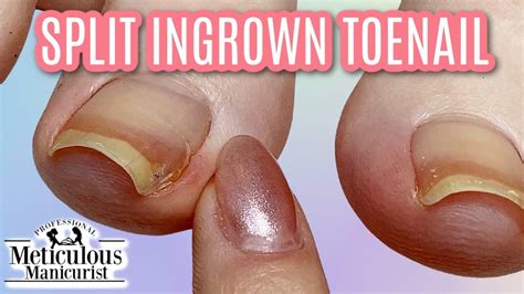 Ingrown Toenail Cure Youtube