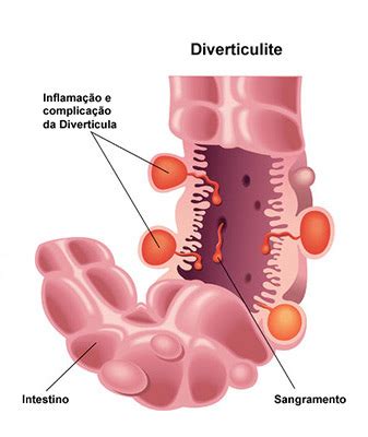 Diverticulite Aguda Grupo Surgical