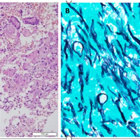 A Granulomatous Reaction With Giant Cells Hematoxylin And Eosin X