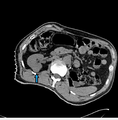 Renal Ct Demonstrating An Exophytic Soft Tissue Mass Along The