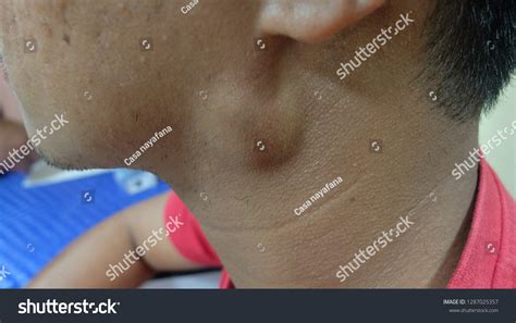 Preauricular Swelling Differential Diagnosis Parotid Swelling Foto