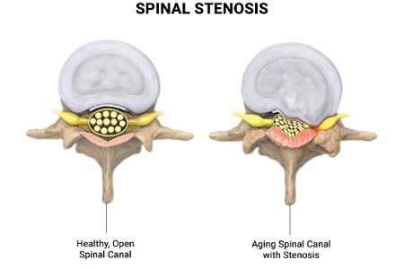 Spinal Stenosis Surgery Cost in India