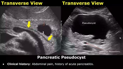 Chronic Pancreatitis Ultrasound