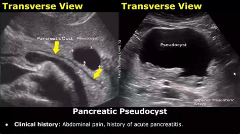 Pancreas Ultrasound Reporting Diseases Scan Reports How To Write