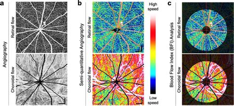 Multi Interscan Time Oct Angiography And Blood Flow Index Bfi