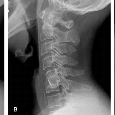 Thirty-eight-year-old female status post ACDF-CA at C5–C6, (A)... | Download Scientific Diagram