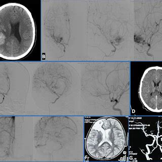 A Ncct Non Contrast Computed Tomography Of Head Of A Years Old