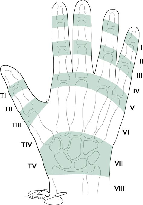 The Optimal Orthosis And Motion Protocol For Extensor Tendon Injury In