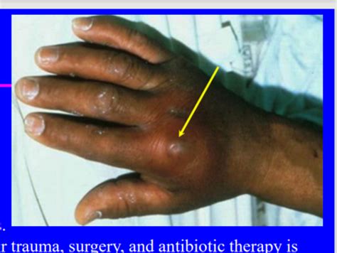 L21 Infections Of Bones And Joints Flashcards Quizlet