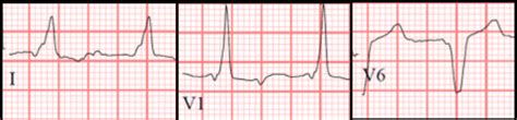 Intraventricular Conduction Delay ECG Made Simple