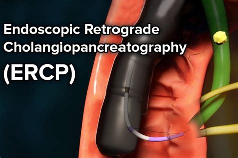 Endoscopic Retrograde Cholangiopancreatography ERCP First Surgery