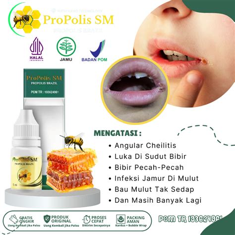 Jual Obat Angular Cheilitis Muncul Luka Di Sudut Bibir Ruam Merah Dan