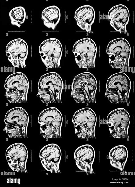 Sequence of vertical sections of a human brain - MRI scan Stock Photo - Alamy