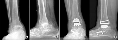 These Are Preoperative Anteroposterior A And Lateral B Radiographs Download Scientific