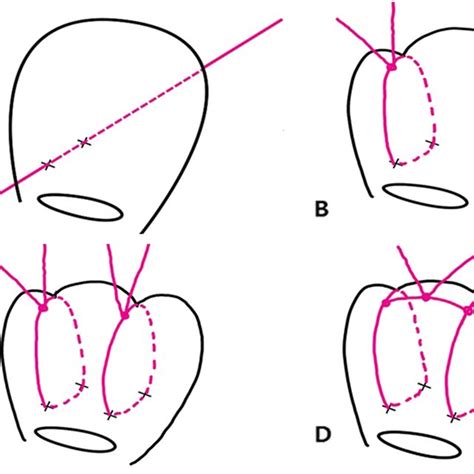 The Cho’s Square Suture Technique A The Straight Needle Was Passed Download Scientific