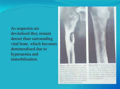 Osteomyelitis