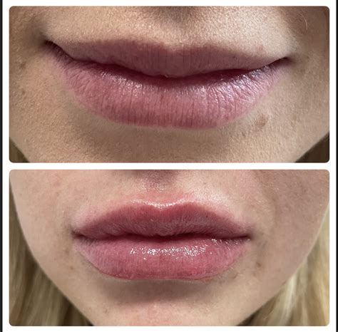 Dermal Fillers Transform Aesthetics