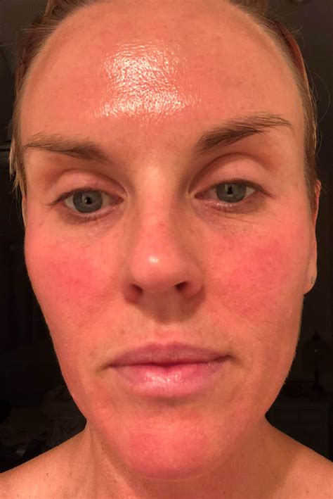 The Key To Perfect Natural Looking Lips Using Lip Filler Injections