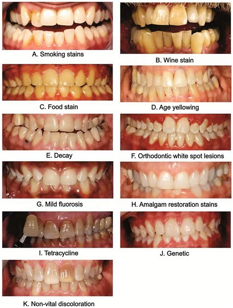 How To Whiten Teeth Naturally Home Treatment Vs Professional Therapy