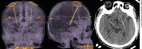 Figure From Bilateral Globus Pallidus Internus Deep Brain Stimulation