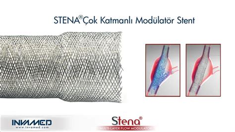 Aort anevrizmasına STENA Stent tedavisi Türkiye Sektörel