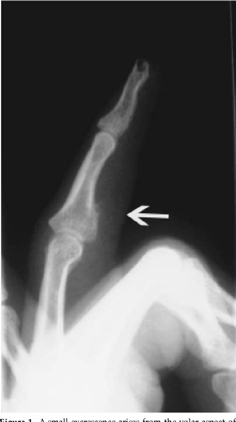 Figure From Bizarre Parosteal Osteochondromatous Proliferation Nora