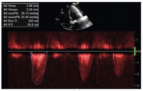 Congestive Heart Failure with a Biventricular Pacemaker | Thoracic Key